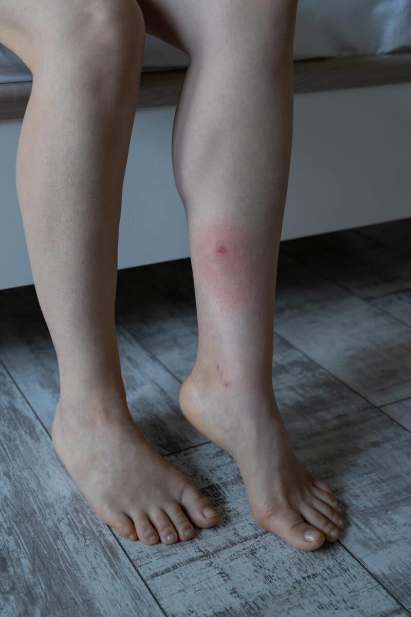 Quelles sont les principales causes d’une infestation de punaises de lit et comment les éviter ?